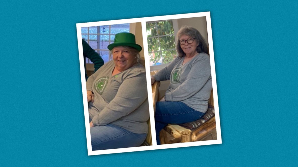 Bariatric Surgery Before And After